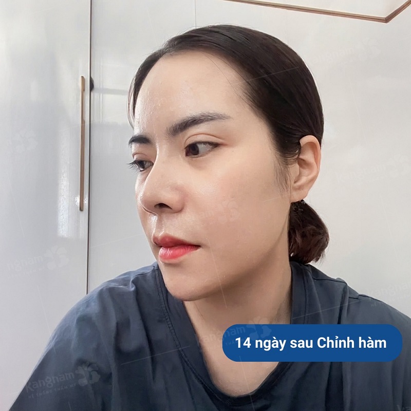 Khách hàng đã hồi phục, xương hàm cân đối sau chỉnh hàm hô 14 ngày