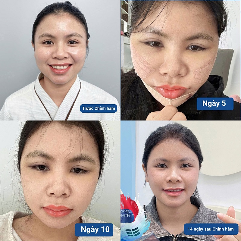 Quá trình phục hồi của khách hàng và các giai đoạn hết đau