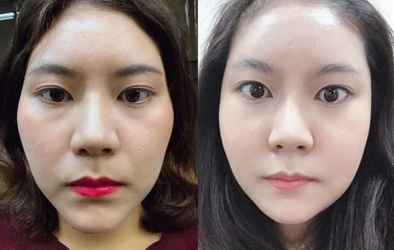 Kết quả thay đổi đường nét khuôn mặt tại Kangnam.
