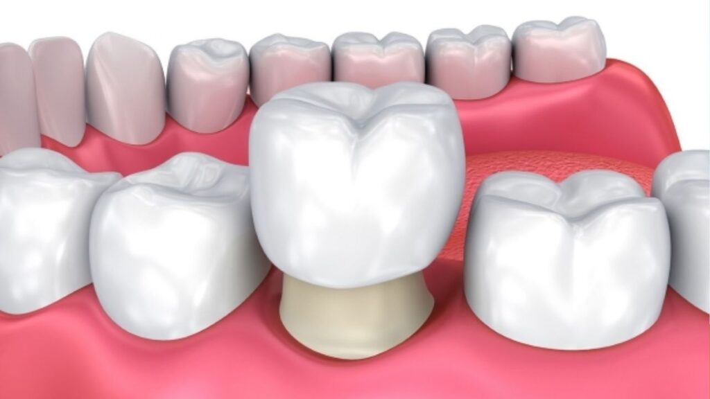 Sau khi chỉnh hàm hô có cần bọc răng sứ không? Tại sao Trà My HTLX cần bọc răng