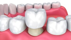 Sau khi chỉnh hàm hô có cần bọc răng sứ không? Tại sao Trà My HTLX cần bọc răng