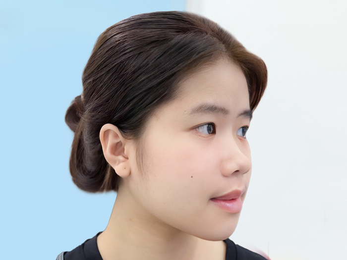 Vùng cằm của khách hàng ổn định sau 14 ngày độn cằm