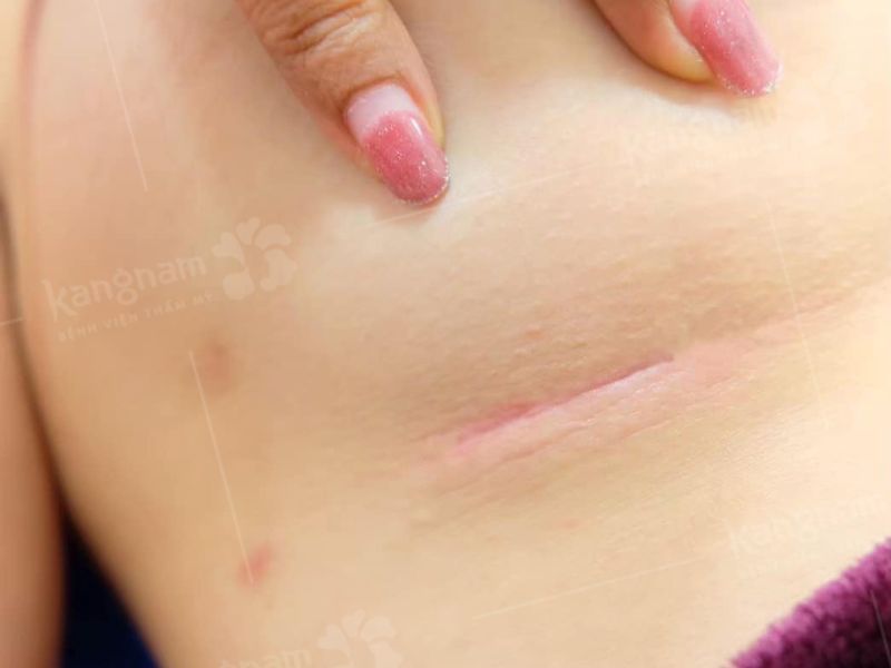 Vết sẹo nâng ngực mờ và không còn triệu chứng ngứa ngáy