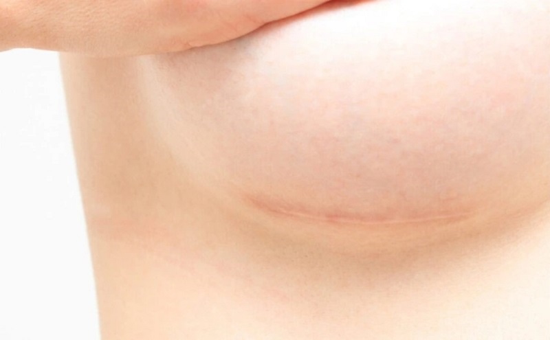 Hình ảnh thực tế vết sẹo nâng ngực nội soi đường chân ngực mờ dần theo thời gian, trùng khít với nếp gấp da.