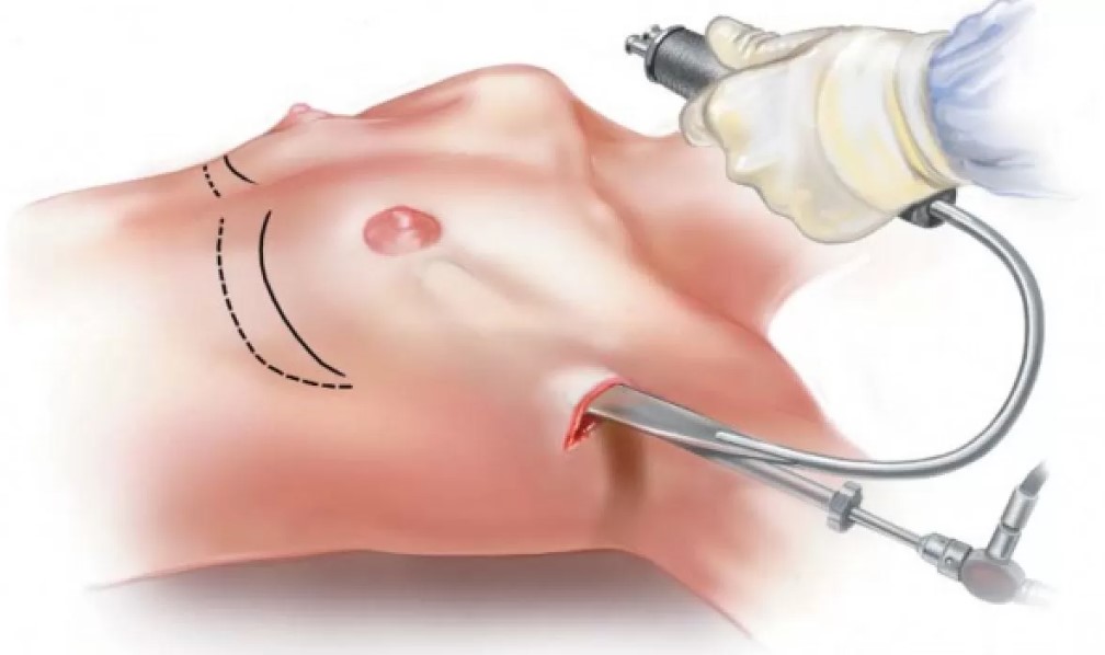 Sơ đồ mô phỏng đường đi của túi ngực từ nếp gấp nách xuống khoang dưới cơ