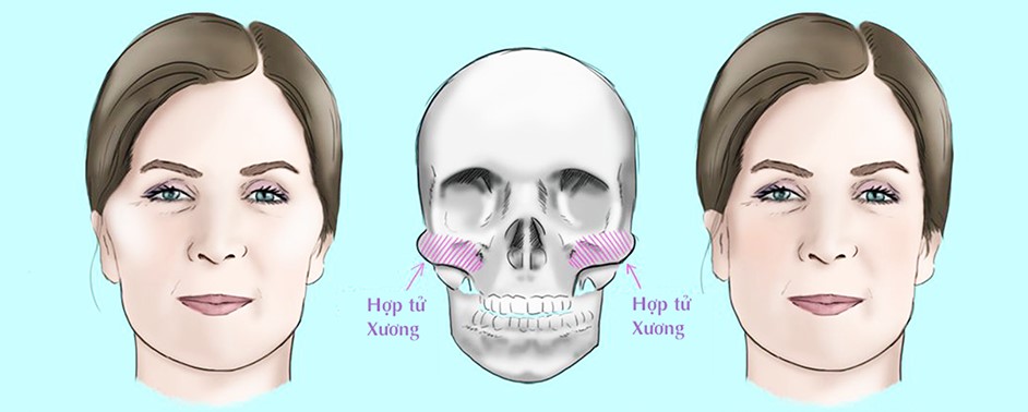 So sánh vị trí can thiệp xương hàm dưới và xương gò má trong phẫu thuật tạo hình khuôn mặt