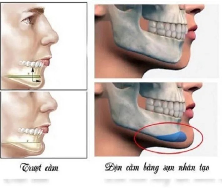 Trượt cằm sử dụng xương tự thân còn độn cằm dùng sụn nhân tạo