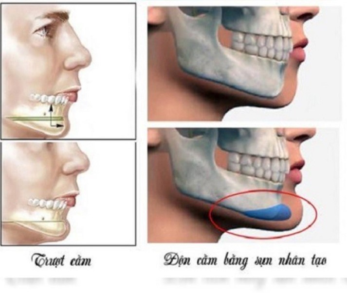 Trượt cằm dùng xương tự thân còn độn cằm dùng sụn nhân tạo