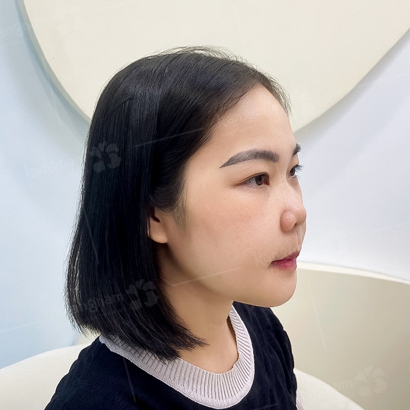 Tình trạng sưng nề tự nhiên vùng gò má sau phẫu thuật chỉnh hình xương hàm mặt.