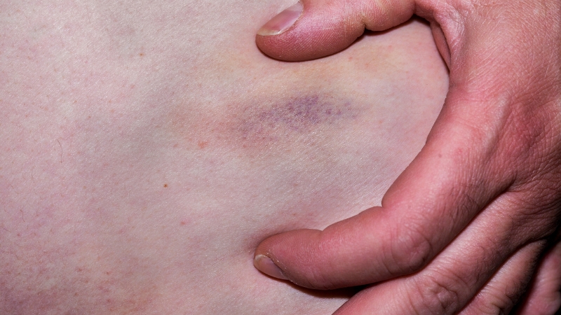 Sưng đau và bầm tím vùng hút mỡ kéo dài cần phải đi tái khám lại để bác sĩ kiểm tra tình hình