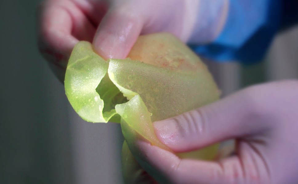 Cần tháo túi độn ngực khi bị hoại tử