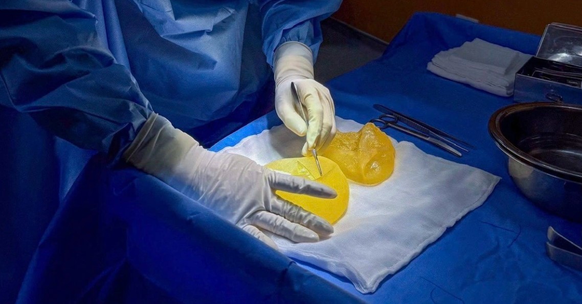 Trường hợp cần tháo túi ngực do bao xơ nghiêm trọng