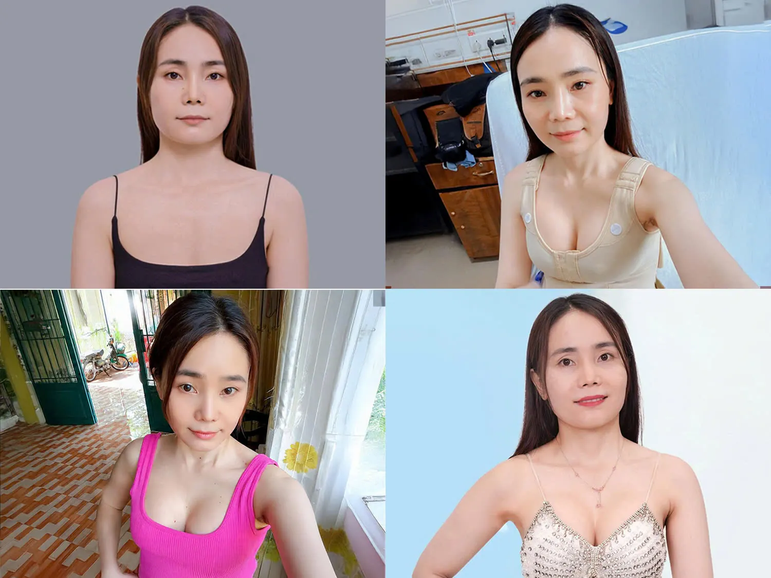 Khách Thúy Nguyễn và quá trình nâng ngực tại Kangnam an toàn, đẹp tự nhiên