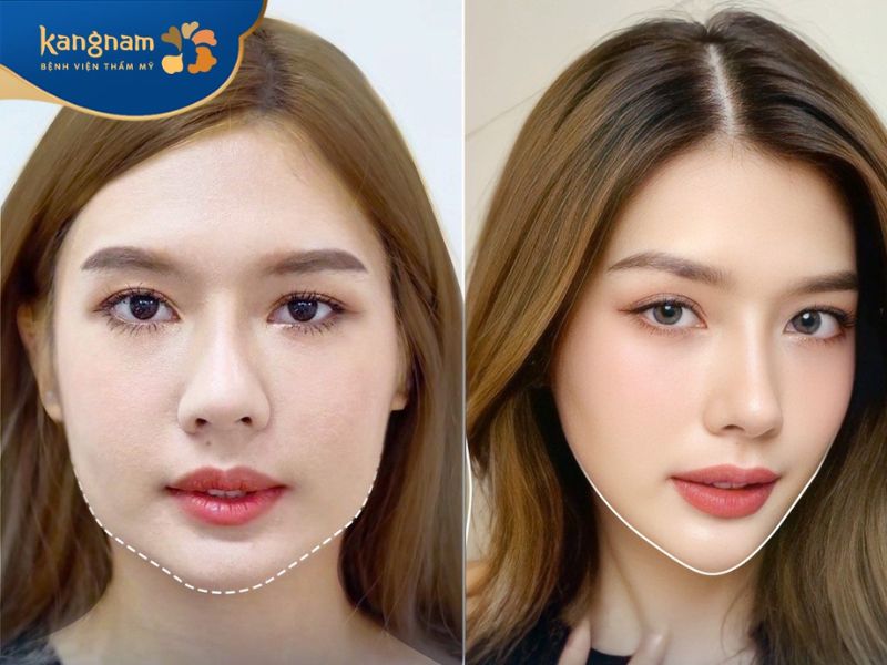 Kết quả khách hàng thực tế trước và sau 1 tháng tiêm Botox thon gọn mặt vuông do cơ tại Kangnam.