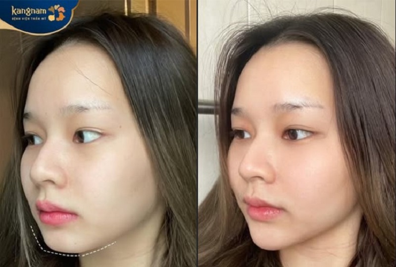 Bác sĩ chuyên khoa tại Kangnam thực hiện tiêm Filler HA giúp kéo dài đầu cằm ngắn ngay lập tức không cần phẫu thuật.