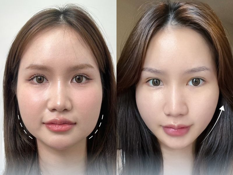 Tiêm botox giúp khuôn mặt thon gọn tạm thời, không gây đau