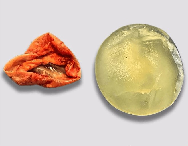 Dùng túi độn kém chất lượng hoặc kỹ thuật đặt túi sai có thể gây bao xơ