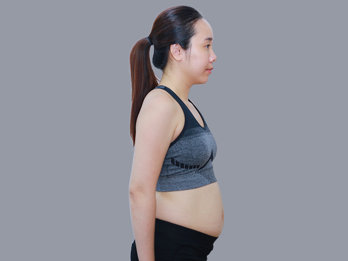 Sơ đồ phân vùng hút mỡ toàn thân bao gồm bắp tay lưng bụng và đùi trong quy trình tạo hình body