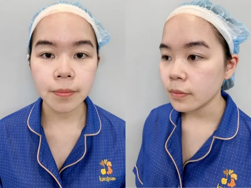 Thanh Thảo trước phẫu thuật, mũi tẹt, Mũi thấp, đầu mũi ngắn, tổng thể thiếu điểm nhấn khi nhìn nghiêng