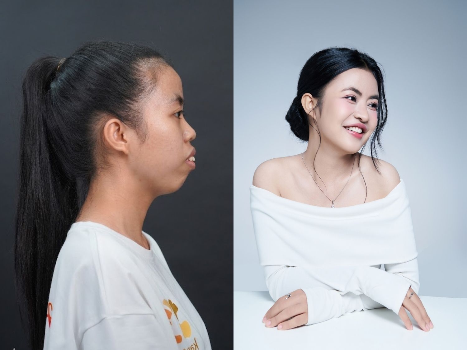 Trà My xinh như hot girl sau chỉnh hàm hô