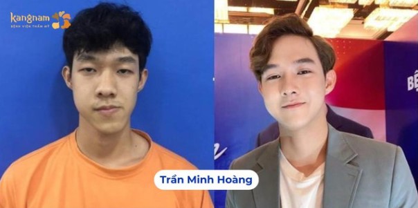 Minh Hoàng lột xác từ gương mặt lệch thành visual chuẩn idol