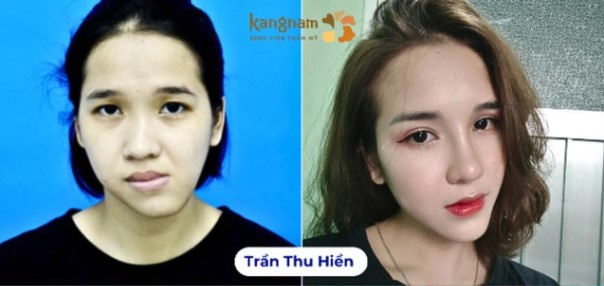 Từng bị chê bai vì mặt móm, Hiền đã “lột xác” với gương mặt thanh tú và thần thái tự tin