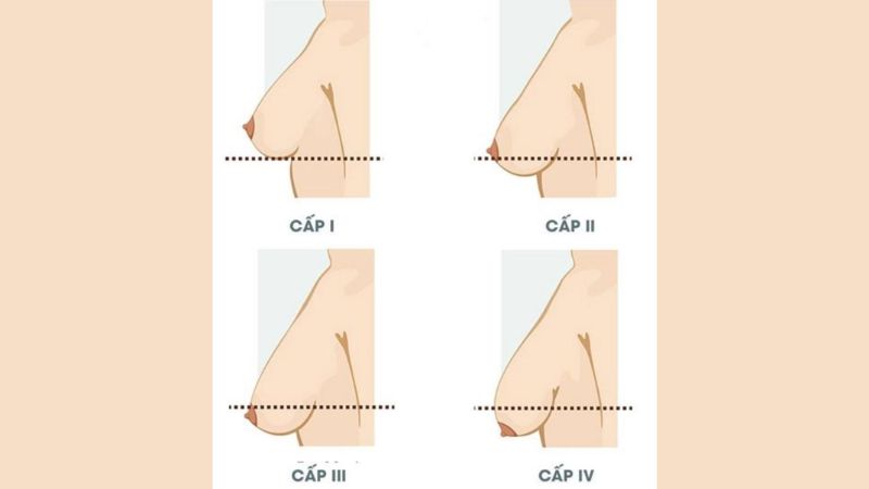 Các cấp độ sa trễ của ngực sau sinh
