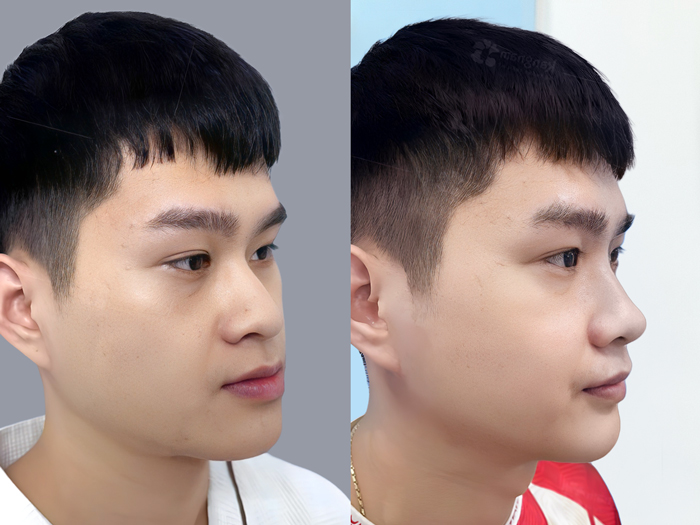 Phẫu thuật chỉnh hàm móm giúp đẩy hai hàm về đúng vị trí cân đối