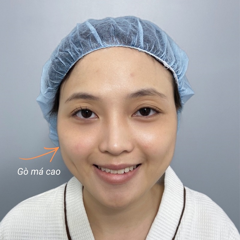 Trường hợp gò má cao nhô ra ngoài cần phẫu thuật hạ gò má để gương mặt hiền hơn.
