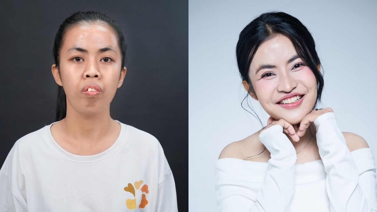 Trà Mỹ trước và sau phẫu thuật