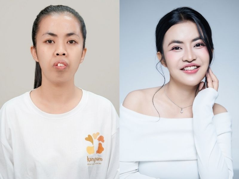 Cô gái mồ côi từng sống trong chùa đã thay đổi ngoạn mục, sở hữu nụ cười rạng rỡ và gương mặt hài hòa