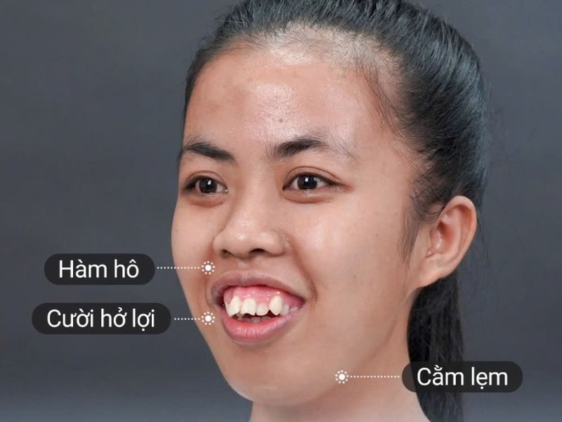 Trà My gặp tình trạng hàm hô nặng, kết hợp cằm lẹm và cười hở lợi