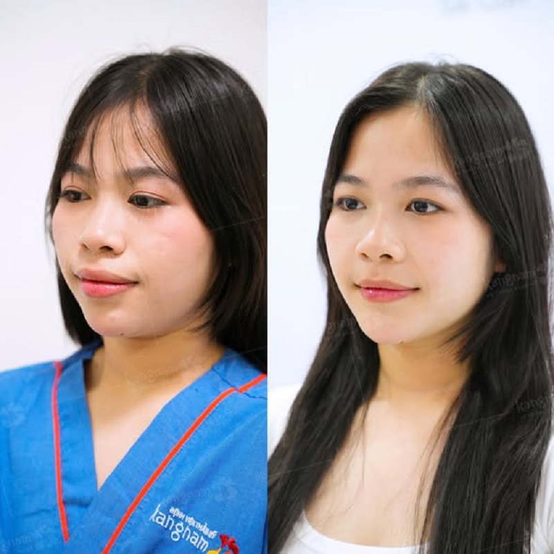 Sau trượt cằm gương mặt khách hàng cân đối, hài hòa hơn