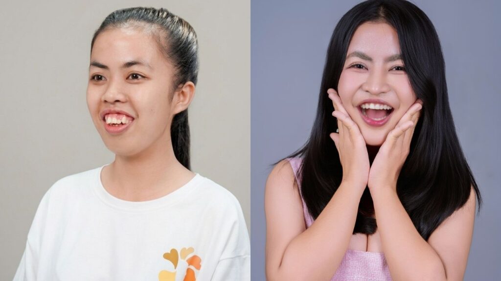 Trượt cằm là gì? Tại sao cần thực hiện cùng với chỉnh hàm