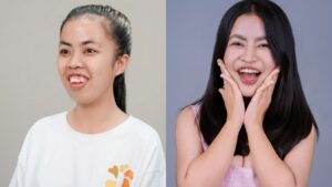 Trượt cằm là gì? Tại sao cần thực hiện cùng với chỉnh hàm