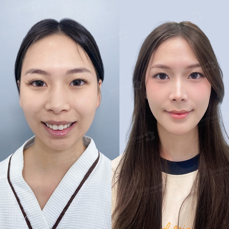Kết hợp độn cằm cùng với chỉnh hàm hô giúp gương mặt cân đối, thanh thoát hơn