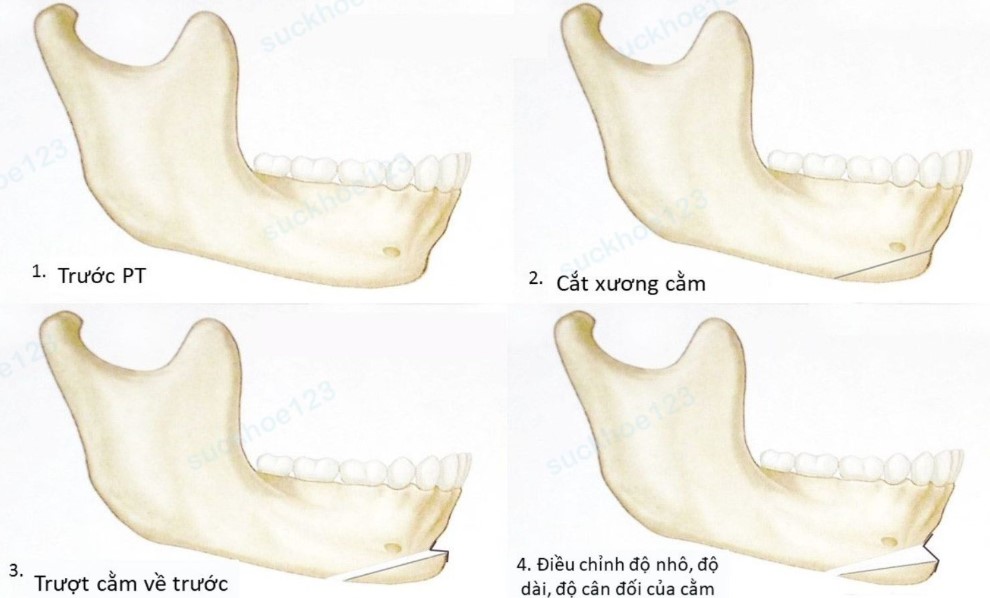 Kỹ thuật trượt cằm cho phép bác sĩ điều chỉnh linh hoạt độ nhô và độ dài của cằm dựa trên cấu trúc xương thật.
