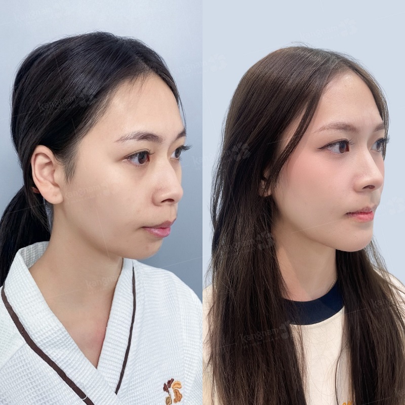 So sánh góc nghiêng cằm ngắn và cằm lẹm thực tế tại Bệnh viện Thẩm mỹ Kangnam để lựa chọn phương pháp can thiệp phù hợp.