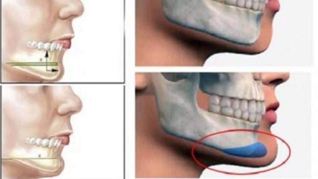 Trượt cằm và độn cằm khác nhau thế nào? Giải pháp nào tối ưu cho cằm lẹm?