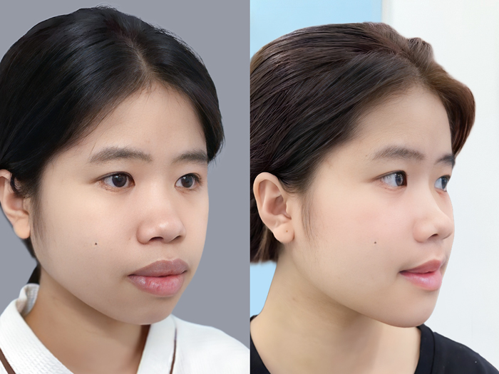 khách trượt cằm sau 1 tháng tại kangnam đã tự nhiên hơn