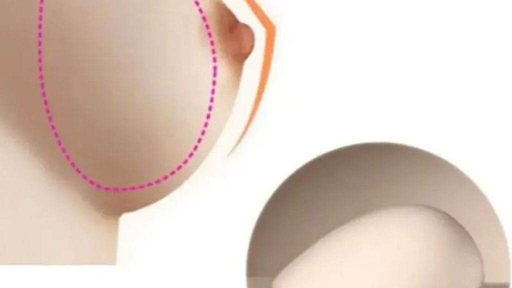 Túi giọt nước có tự nhiên không? Phân tích ưu điểm và kỹ thuật đạt độ thẩm mỹ tối ưu