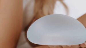 Túi Motiva có bị bao xơ không? Phân tích tỷ lệ thực tế và công nghệ bề mặt Nano kháng viêm