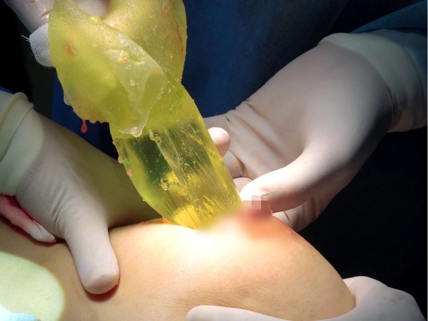 trường hợp thay túi ngực do bị vỡ