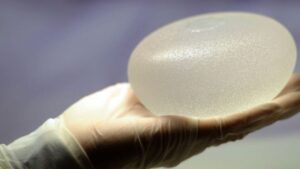 Túi ngực bao lâu phải thay? Giải mã mốc 10 năm và quy trình tầm soát túi an toàn