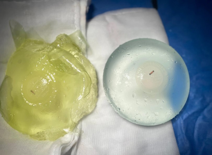 tình trạng bao xơ cần thay túi ngực nếu không sẽ ảnh hưởng đến sức khỏe