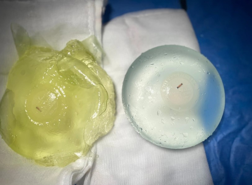 Hình ảnh so sánh mô phỏng giữa một túi ngực có lớp bao mỏng tự nhiên và một túi bị bao xơ dày đặc bao quanh.