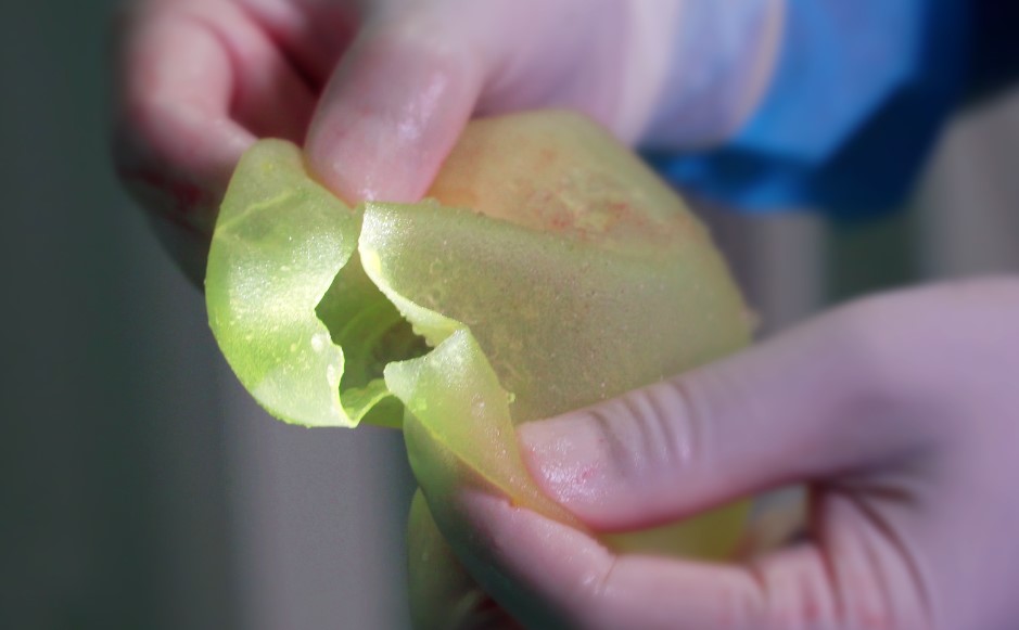 Túi ngực gel sillicone bị vỡ cần được lấy ra khỏi cơ thể