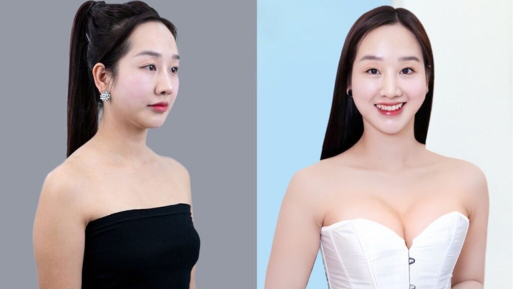 Túi ngực có an toàn không? 9 sự thật cần biết trước khi nâng ngực