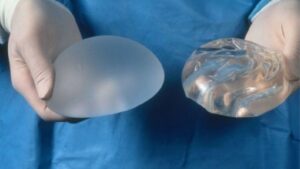 Túi ngực Silicone là gì? 7 Sự thật về độ bền và an toàn bạn cần biết