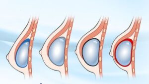 Túi nhám có bị bao xơ không? Cách kiểm soát biến chứng từ chuyên gia